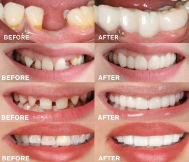 Removable Cosmetic Tooth Set for a Natural-Looking Smile