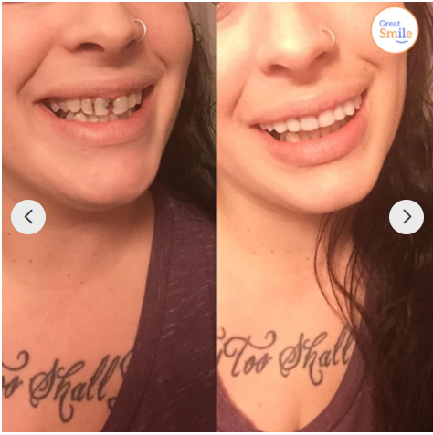 Removable Cosmetic Tooth Set for a Natural-Looking Smile
